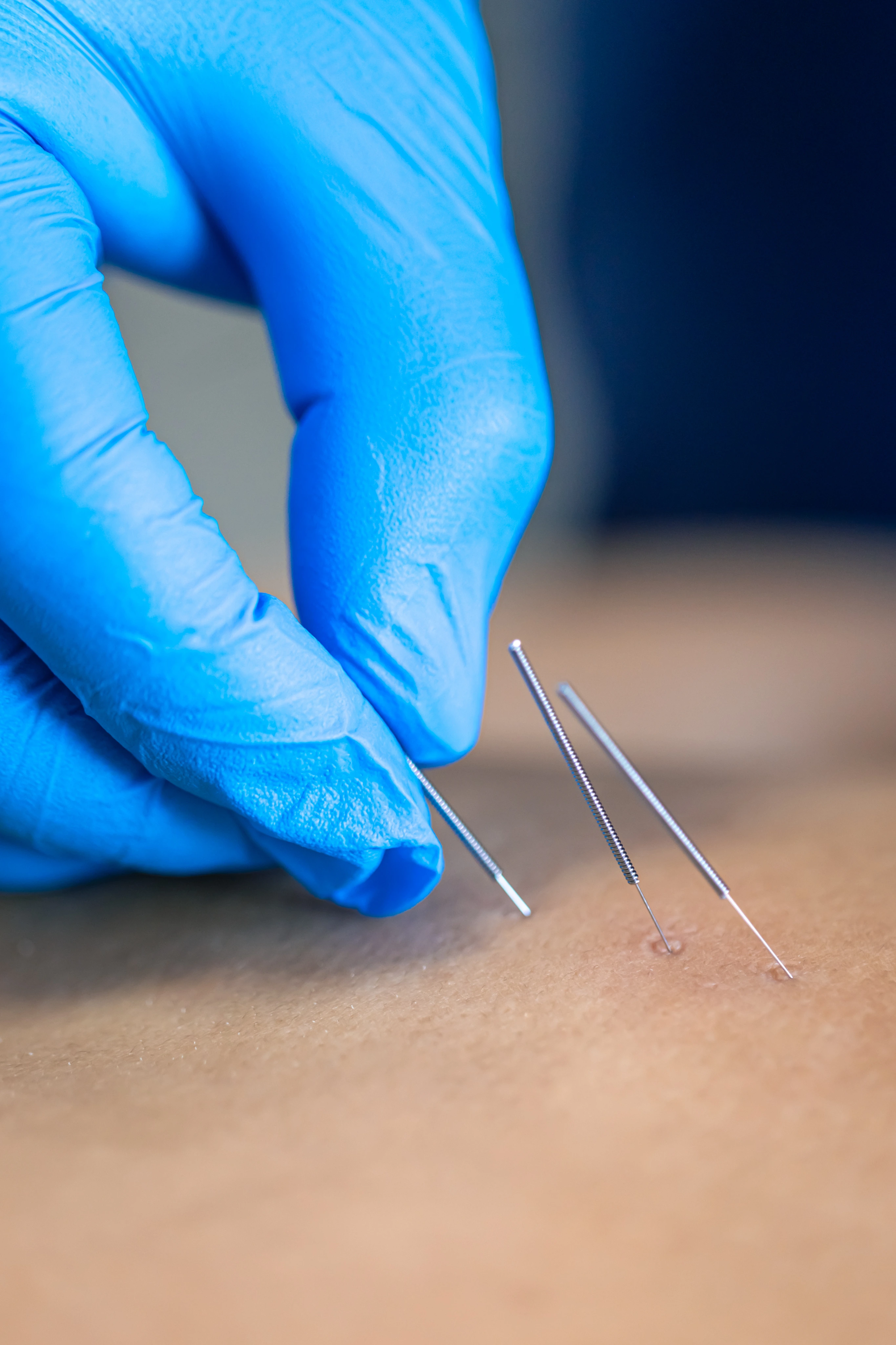 A practitioner placing an acupuncture needle