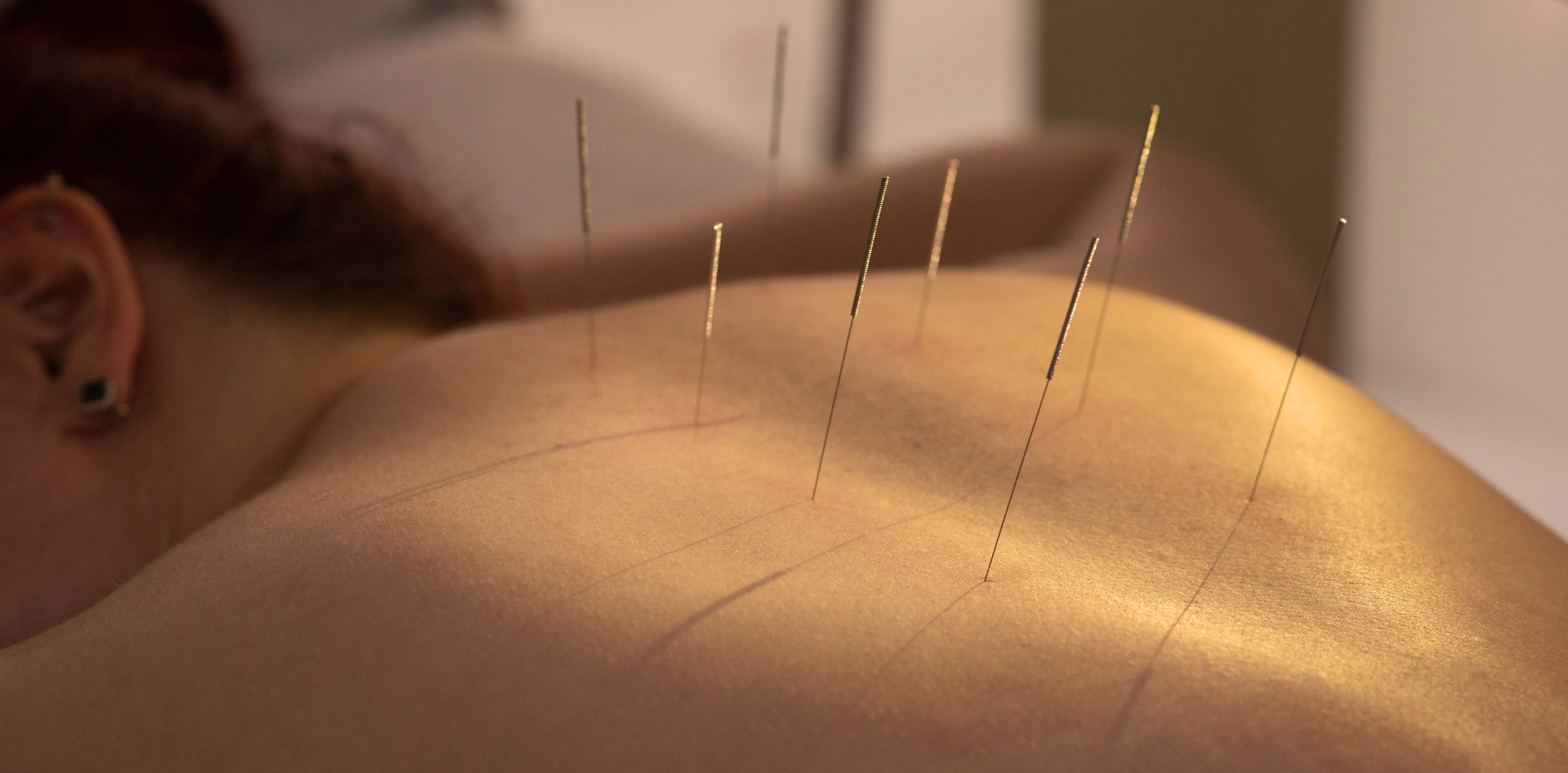 Acupuncture needles placed along a patient&rsquo;s back
